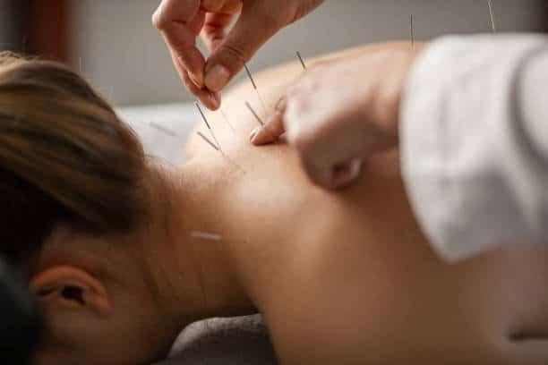 acupuncture